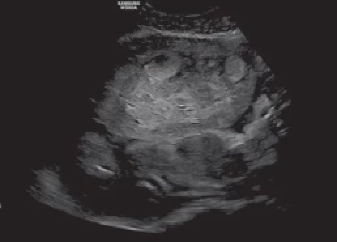 Detail of the voluminous retroplacental hematoma measuring 8 × 5 cm on transabdominal ultrasound performed with a Hera WS80A apparatus (Samsung Corp., Seoul, South Korea). </br>Obr. 3. Detail objemného retroplacentárního hematomu o rozměrech 8 × 5 cm na transabdominálním ultrazvuku provedeném přístrojem Hera WS80A (Samsung Corp., Soul, Jižní Korea).