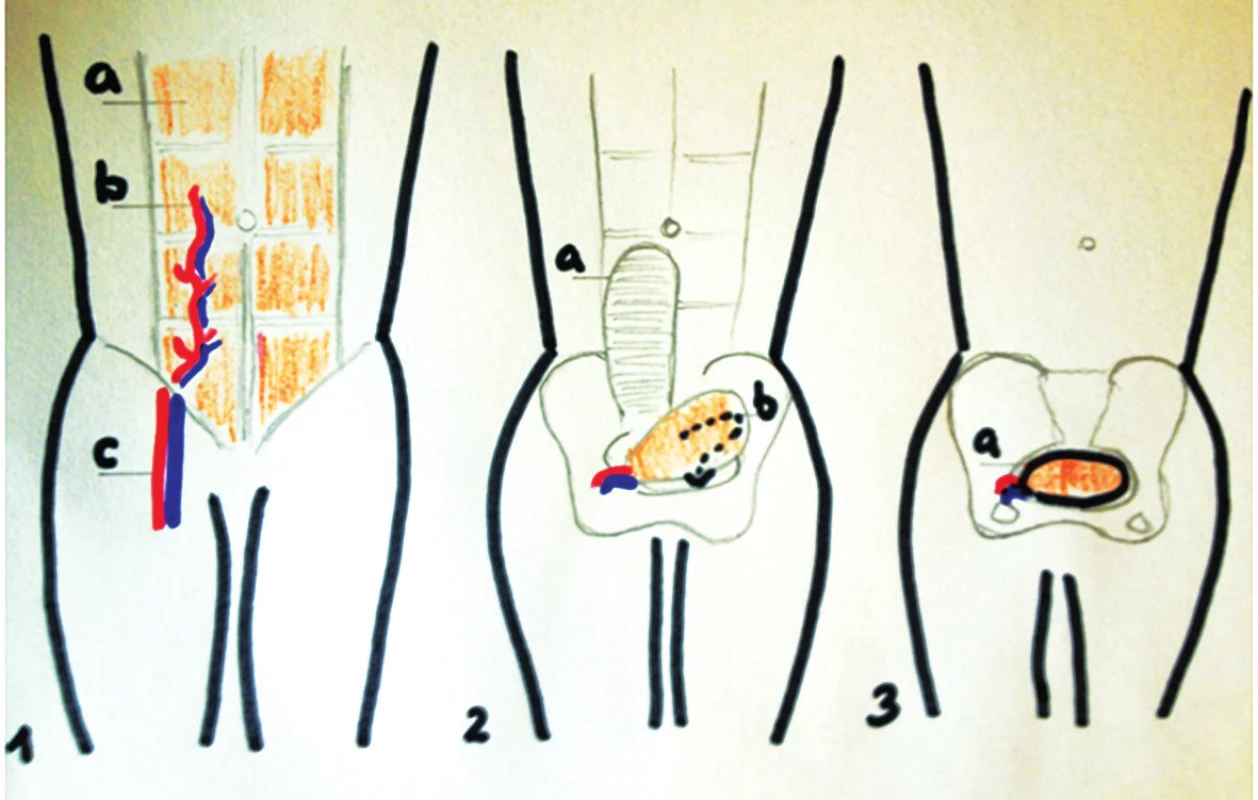 Metoda laloku RAM: 
1. a) m.rectus abdominis, b) cévní svazek − a.et v.epigastricae inf, c) a.et.v. femoralis. 2. a) pochva přímého břišního svalu, b) směr rotace. 3. a) lalok umístěný v pánvi. Volně dle [7]
Fig. 3: RAM flap method:
1. a) rectus abdomins muscle. b) rectus abdominis muscle blood supply from inferior epigastric artery and vein, c) femoral artery and vein. 2 a) rectus abdominis muscle sheath,b) arc of muscle flap rotation. 3. a) positioning of rectus muscle into the pelvis. Freely adapted from [7]