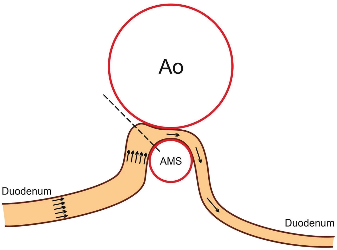 Schematické znázornění abnormální morfologie syndromu horní mezenteriální arterie.
Fig. 1. Abnormal morphology in superior mesenteric artery syndrome.