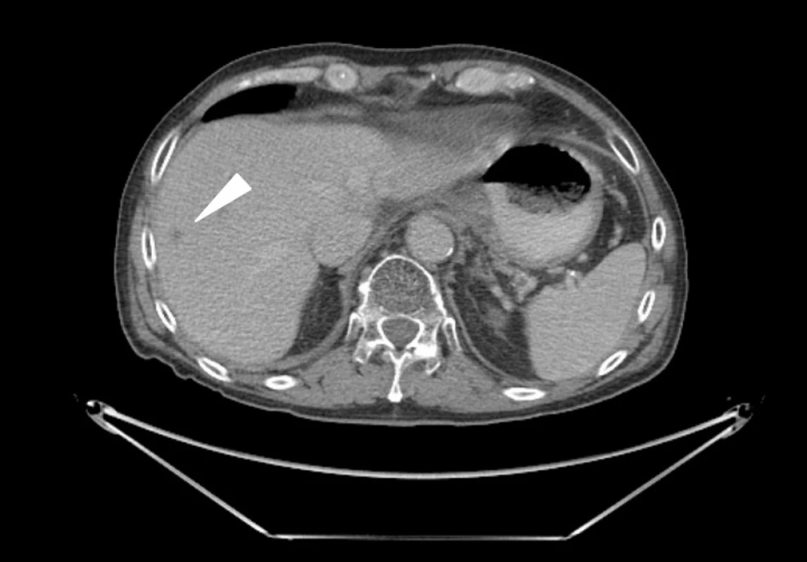 CT vyšetření břicha: v pravém jaterním laloku na hranici S VII/VIII je asi 2 cm velké, hypodenzní, subkapsulárně uložené ložisko odpovídající metastáze adenokarcinomu žaludku (šipka)
Fig. 1: Abdominal CT scan: liver metastasis of gastric cancer – tumour of 2 cm in size in the right lobe of the liver – segment VII/VIII (arrow)