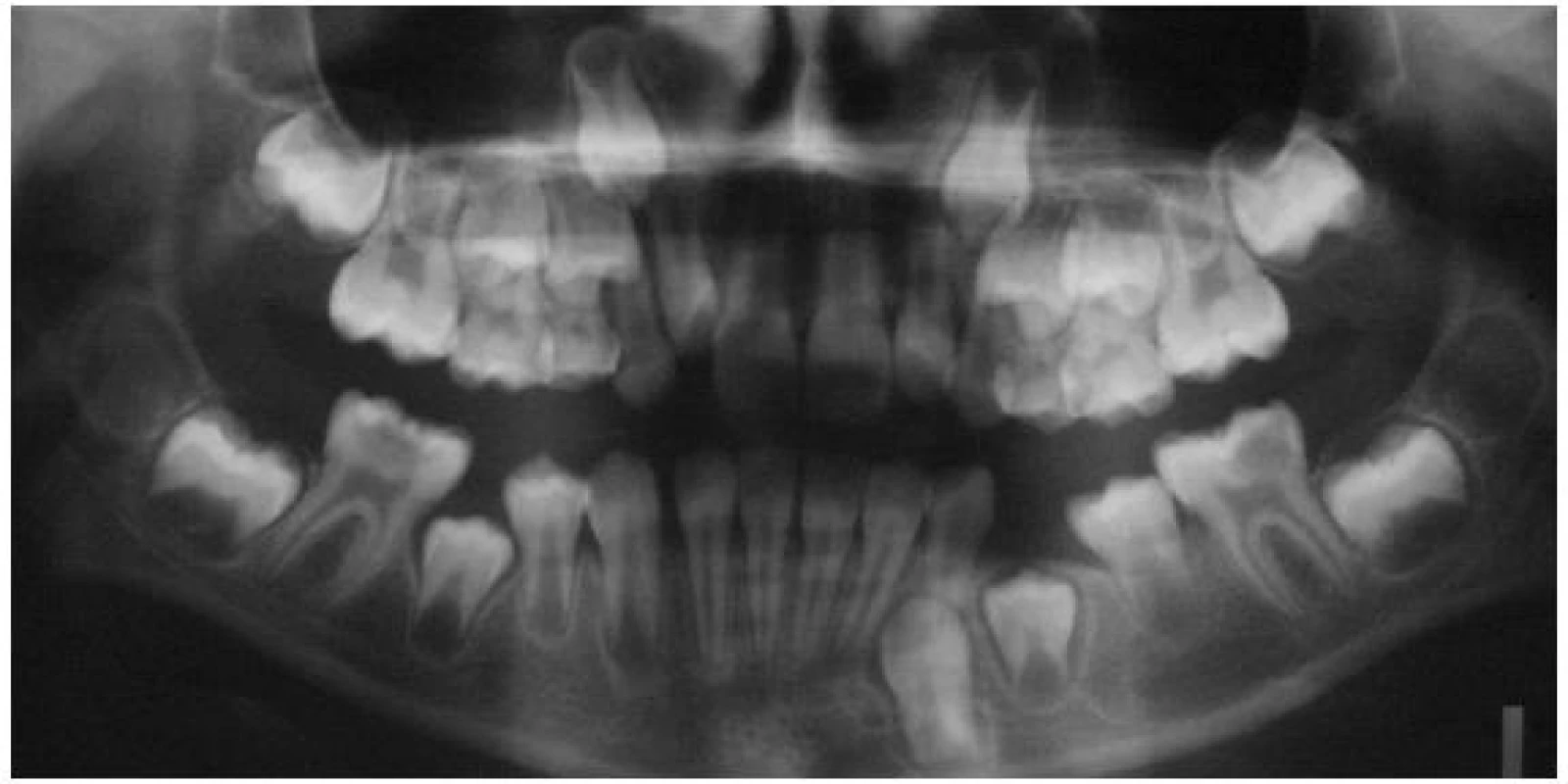 Ortopantomogram pacientky s patrnou předčasnou erupcí zubu 35