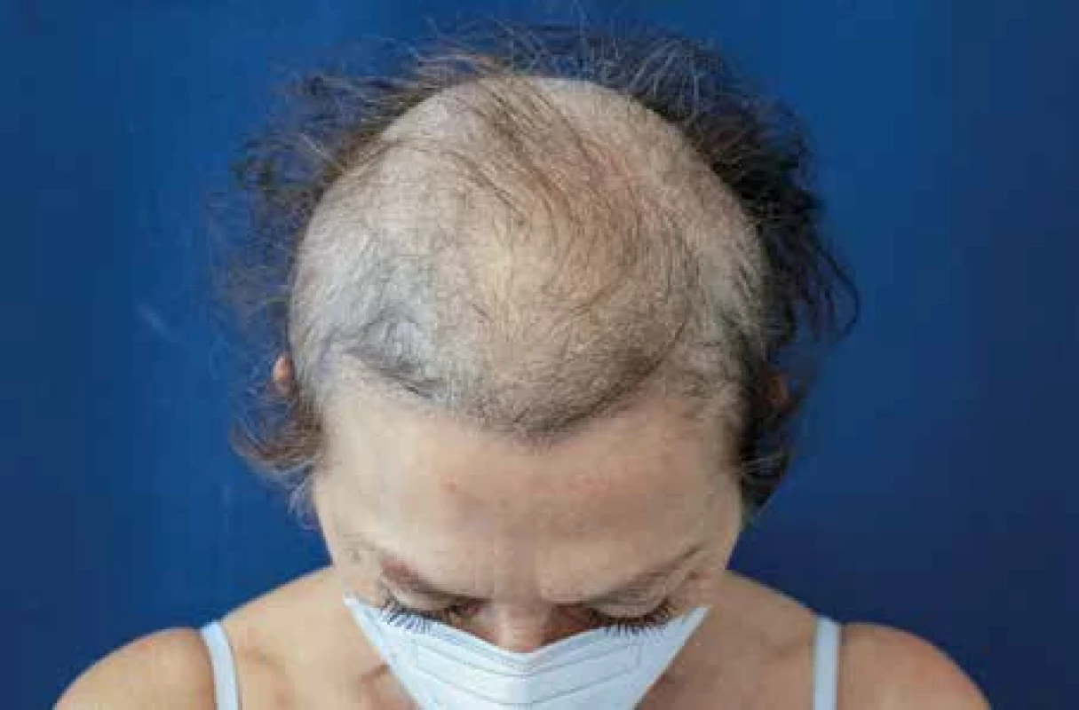 Androgenní alopecie, histologicky verifikovaná. [Foto: Z archivu Dermatovenerologické kliniky 2. LF UK a FNB.]