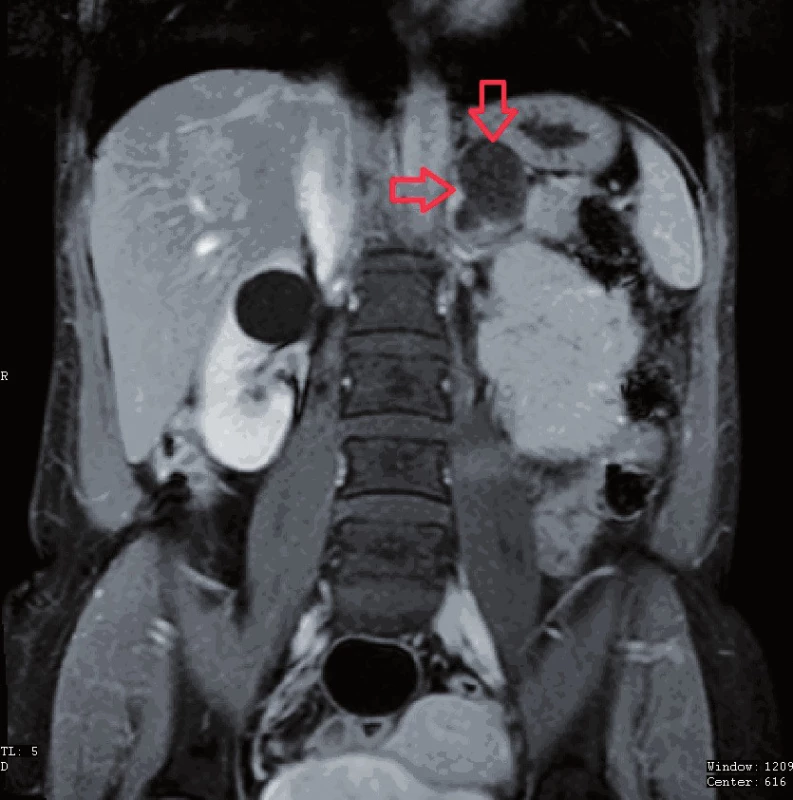 MR – T1 vážený obraz
Fig. 1. MRI – T1 weighted image