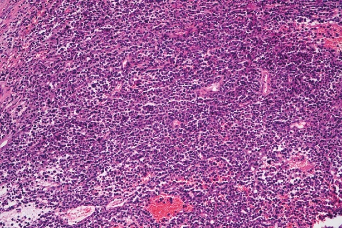 Histopatologický preparát (hematoxylin-eozin, původní zvětšení 200×). Nádor sestává z difuzně rostoucí populace zralých plazmatických buněk.