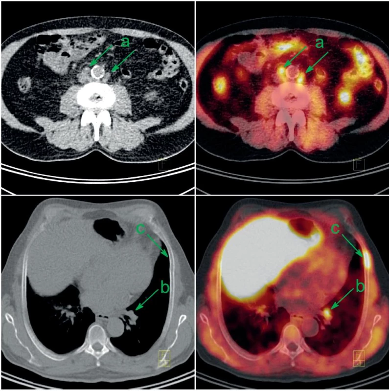 Pacient po radikální prostatektomii s biochemickou recidivou a retroperitoneální lymfadenopatií byl indikován k FCh-PET/CT. Patologicky zvýšená konsumpce cholinu v mírně zvětšených retroperitoneálních uzlinách (a), v nezvětšené interlobární uzlině vlevo (b) a v kostní dřeni 6. žebra vlevo (c) svědčí pro generalizaci karcinomu prostaty. V játrech a ve střevech je akumulace FCh fyziologicky zvýšená. Vlevo CT v režimu velmi nízké dávky, vpravo jeho fúze s FCh-PET.
Fig. 2. Patient after radical prostatectomy with biochemical recurrence and retroperitoneal lympadenopathy was indicated to FCh-PET/CT. Abnormally increased choline consumption in slightly enlarged retroperitoneal lymph nodes (a), in normal-size interlobar lymph node on the left (b) and in the bone marrow of 6<sup>th</sup> rib on the left (c) represents recurrent metastatic prostate cancer. Increased choline uptake in the liver and gut is a normal variant. Left: minimal-dose CT; right: fusion of minimal-dose CT with FCh-PET.
