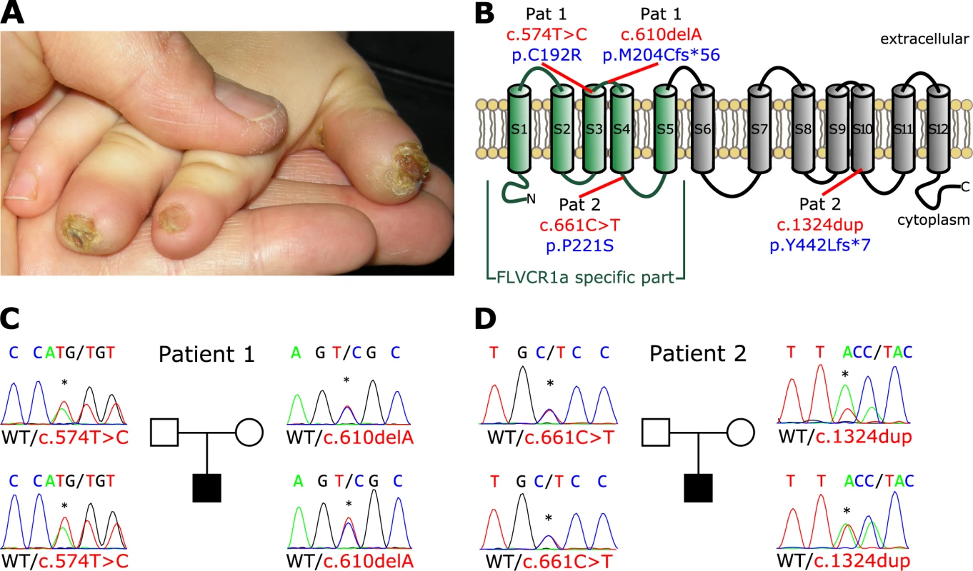 Mutations in the <i>FLVCR1</i> gene cause Sensory Neuropathy.