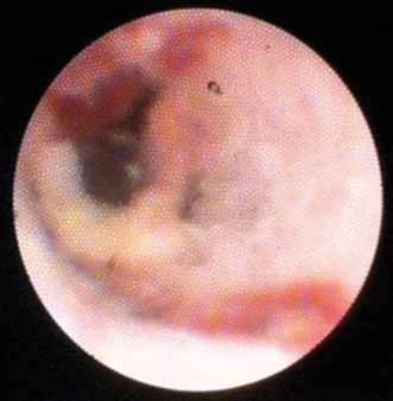Nekróza po extrakci plastového stentu.
Fig. 9. Necrosis after extraction of a plastic stent.