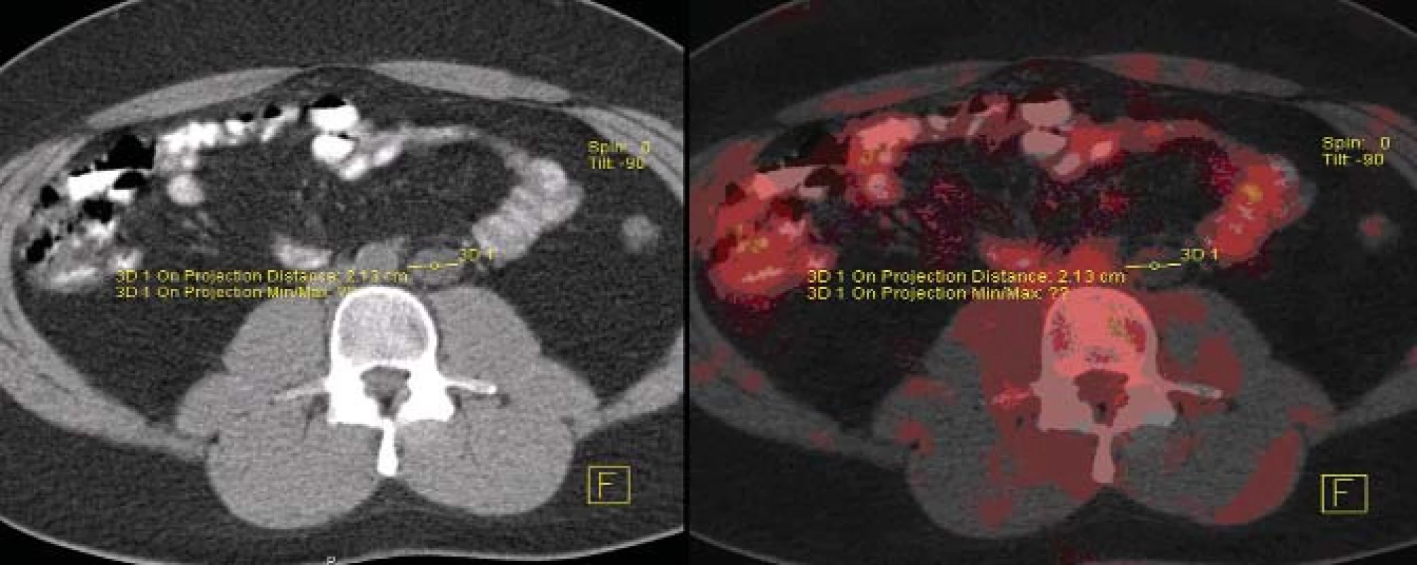 PET/CT pacienta s perzistující retroperitoneální masou po chemoterapii.