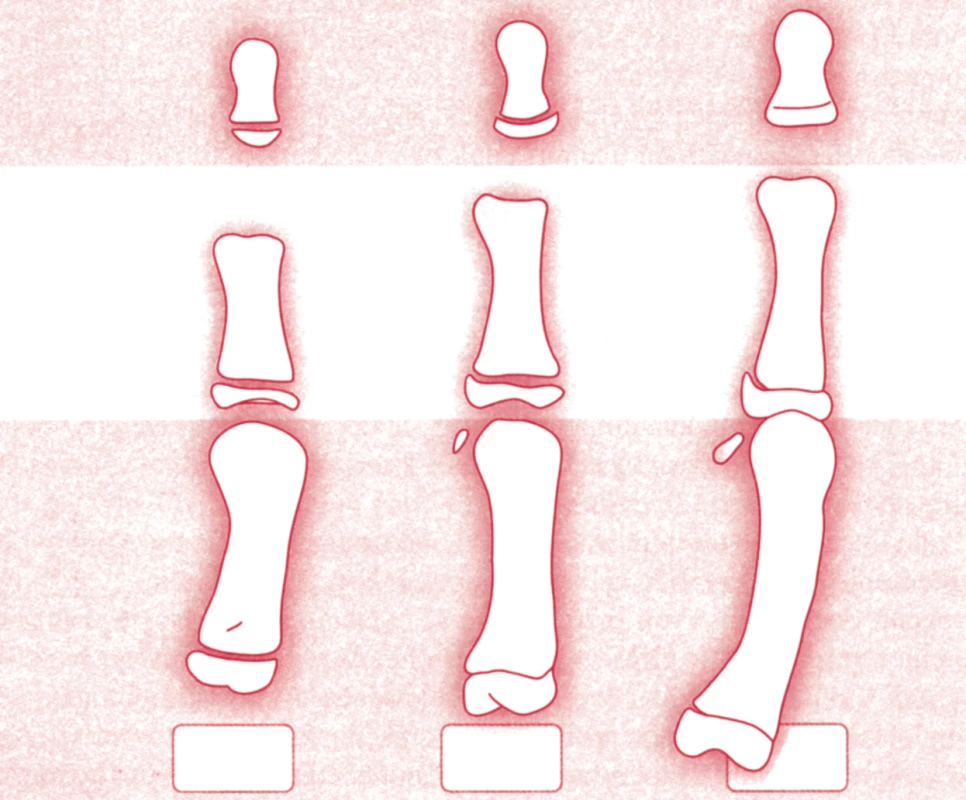 Kostní maturace ve vztahu k růstovému spurtu: distální falanga třetího prstu DPh3, proximální falanga prvního prstu PPh1, první metakarp MTC1.
A – před spurtem, B – v době spurtu, C – při menarche.