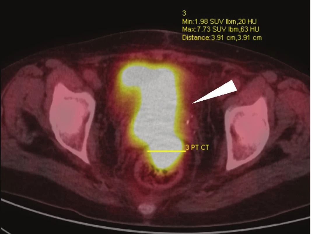 PET/CT vyšetření, axiální skeny: rozsáhlý tumor malé pánve, postihující rektum, pochvu a močový měchýř (bílá šipka) – předoperační vyšetření u stejné nemocné jako na Obr. 1.
Fig. 2: PET/CT, axial scans: extensive tumour of the small pelvis, invading the rectum, vagina and urinary bladder (white arrow) – preoperative assessment in the same patient as in Fig. 1.