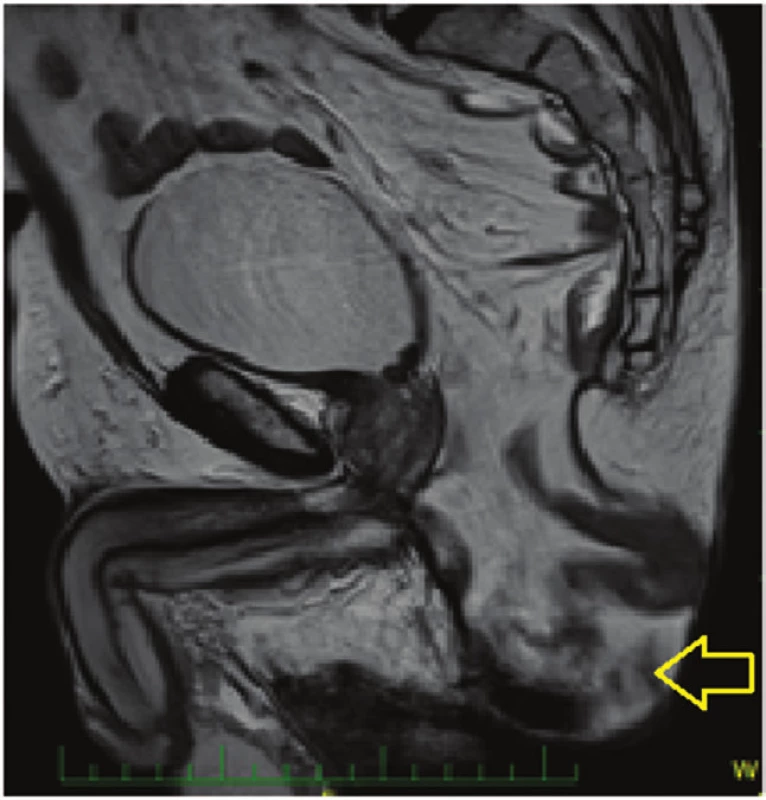 Perineální kýla - MRI nález
Fig. 2: Perineal hernia – MRI image