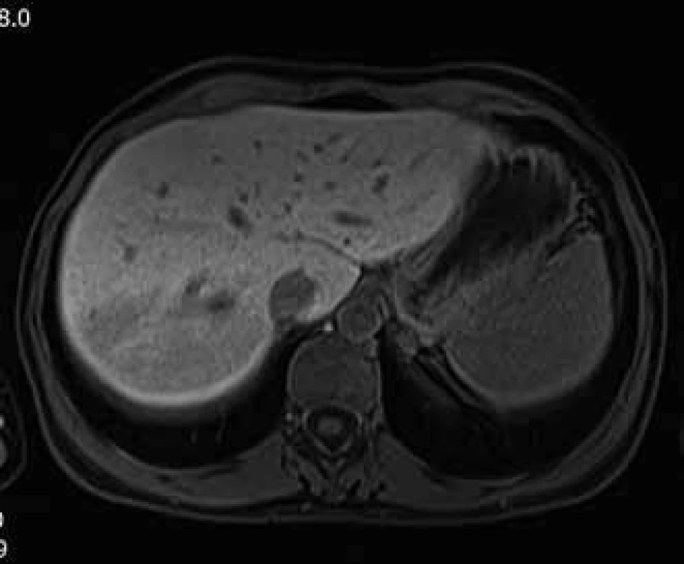 Magnetická rezonance jater.
Fig. 4. Magnetic resonance of liver.