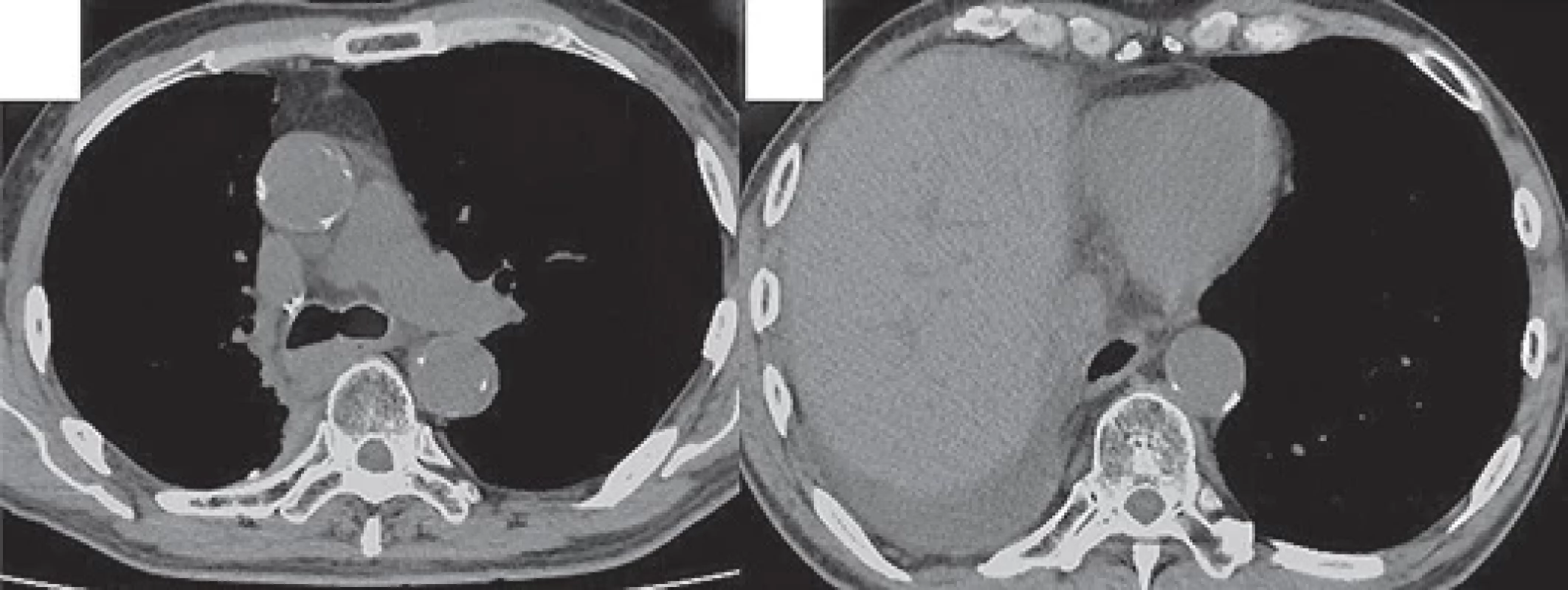 Chest CT performed 2 years after starting nivolumab and ipilimumab therapy shows no recurrence (A, B).