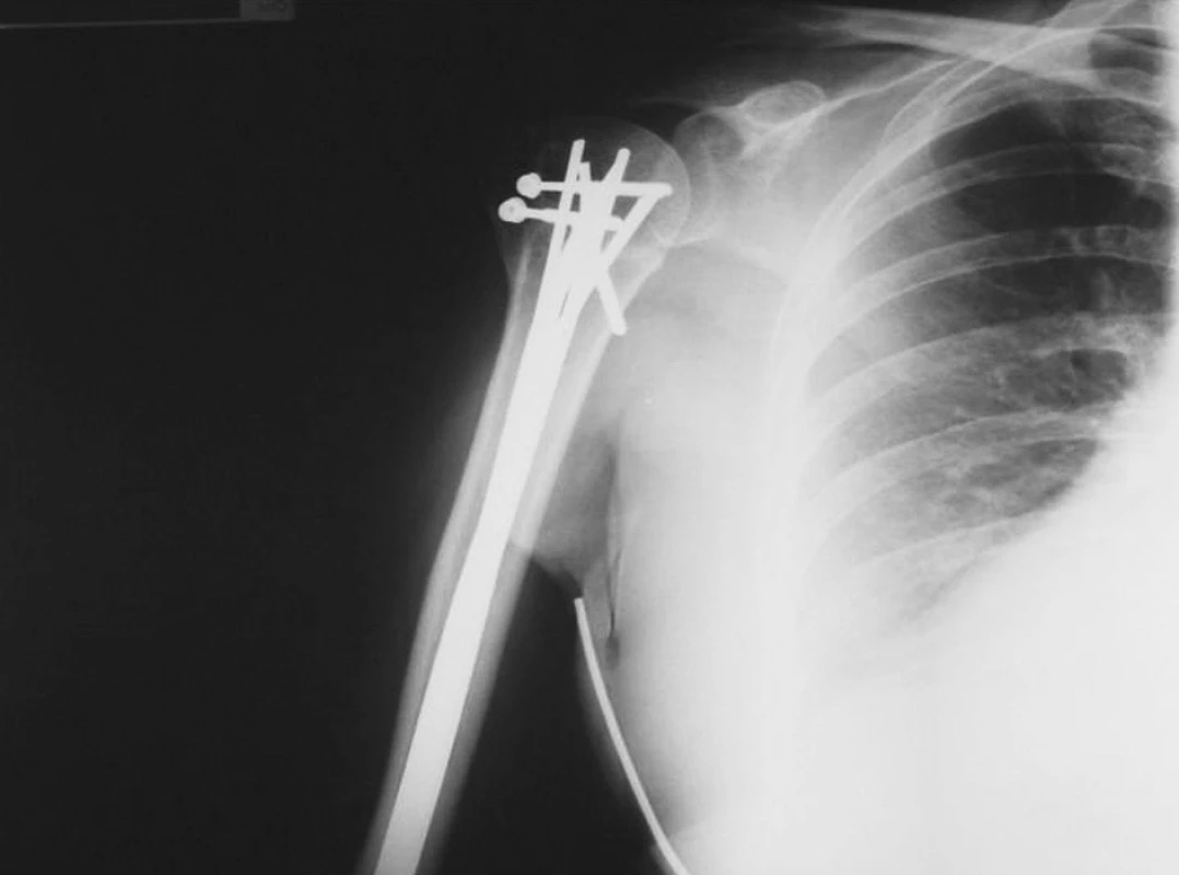 RTG obraz stavu po zhojení zlomeniny, řešené transfixací K-dráty a samostatnou osteosyntézou odlomeného velkého hrbolu 2 šrouby
Fig. 8. X-ray view after healing of the fracture, managed by transfixation with K-wires and separate osteosynthesis of the broken off greater tubercle using 2 screws