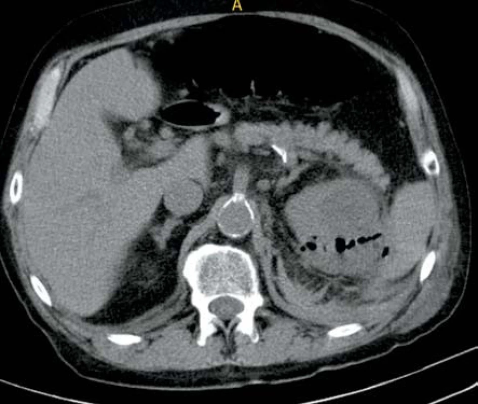 Ledvinný absces levé ledviny s mnohočetnými ložisky plynu
Fig. 5. Abscess in left kidney with multifocal gas deposits