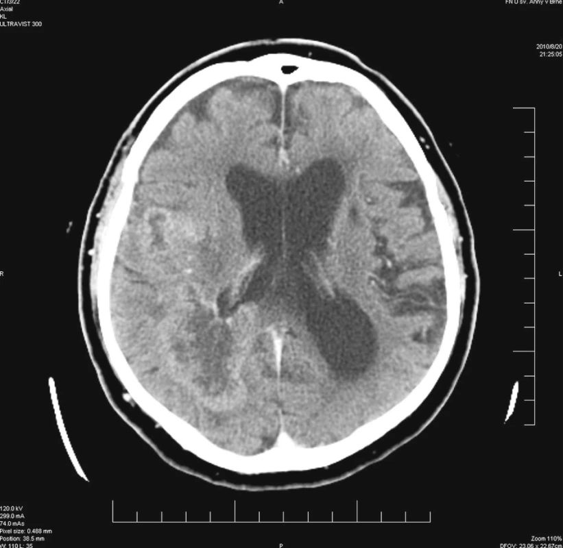 Postkontrastní CT vyšetření se dvěma sytícími se nádorovými uzly
Fig. 1. Post-contrast CT examination with two contrast uptaking tumor nodes