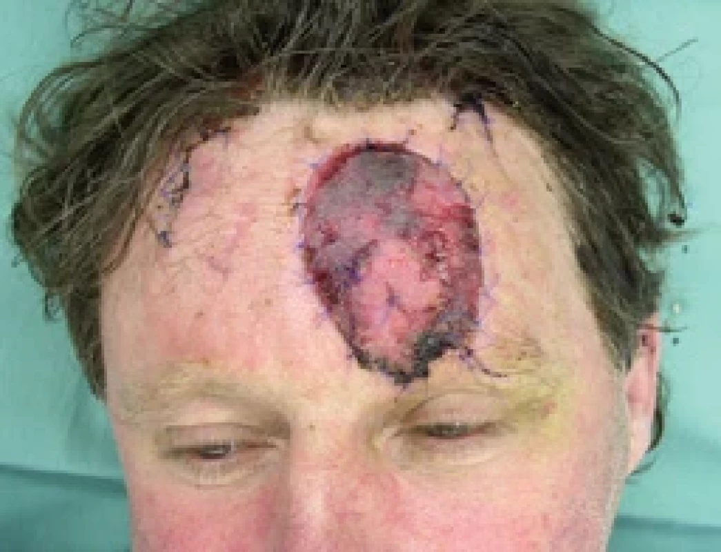 Flap ischemia 3rd day after revision. Source: archive of authors.