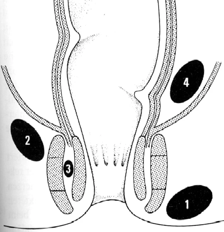 Typy perianálních abscesů
1 – subkutánní, 2 – ischiorektální, 3 – intersfinkterický, 4 – pelvirektální
Fig. 1: Types of perianal abscess
1 - subcutaneous 2 - ischiorectal 3 – intersphincteric, 4 – pelvirectal