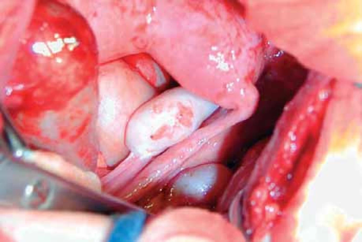 Nález při laparotomii: hematometra v rudimentárním rohu vlevo a hematosalpinx vlevo.