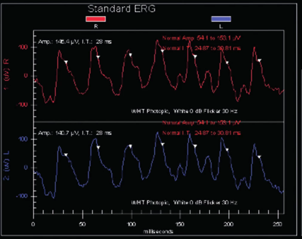 Elektroretinogram v skotopickom a fotopickom zbere, flicker ERG