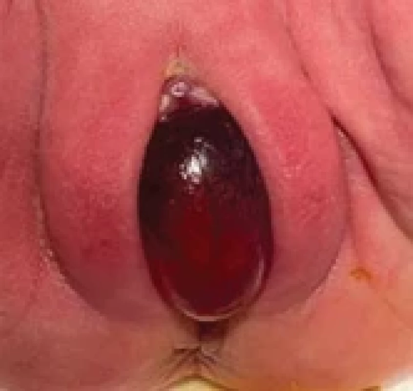 Prolapse of an ectopic ureterocele in a10-day-old girl. Obr. 3. Prolaps ektopické ureterokély u 10denní dívky.