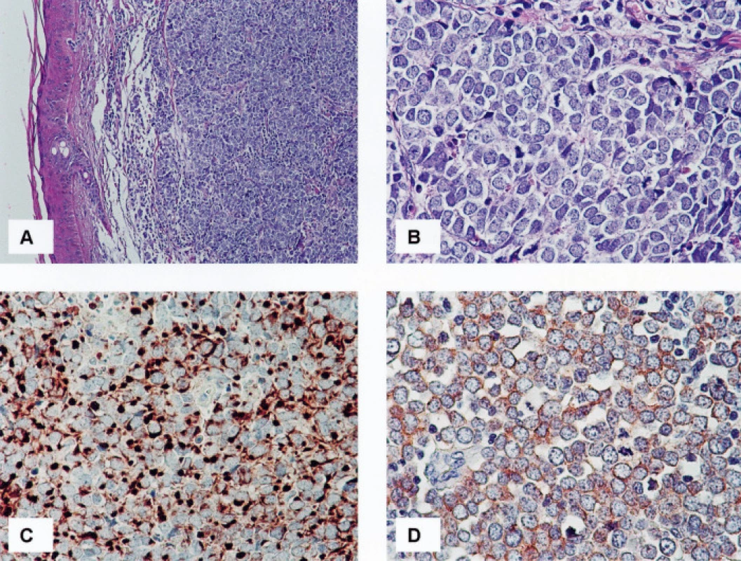 1A, B. Karcinom z Merkelových buněk, HE, 100x (A) a 400x (B)
1C. Čepičkovitá („dot-like“) pozitivita cytokeratinu 20 v cytoplazmě nádorových buněk, 400krát
1D. Jemně granulární pozitivita chromograninu A v cytoplazmě nádorových buněk, 400krát