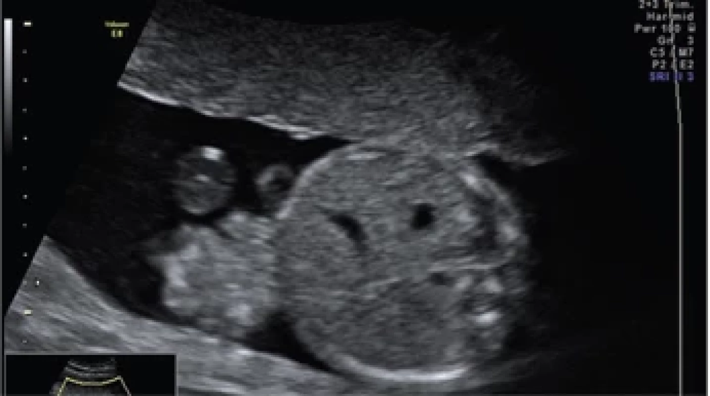 Ultrazvukový nález jednoduché gastroschízy. 19. týden gravidity: prolaps střevních kliček mimo dutinu břišní paraumbilikálním defektem.