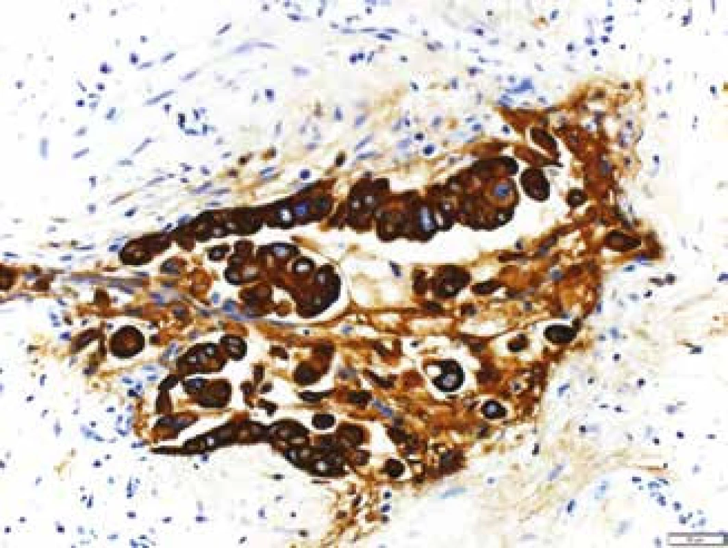 Imunohistochemický průkaz CK 7 v nádorových buňkách v řezech z cytobloku.