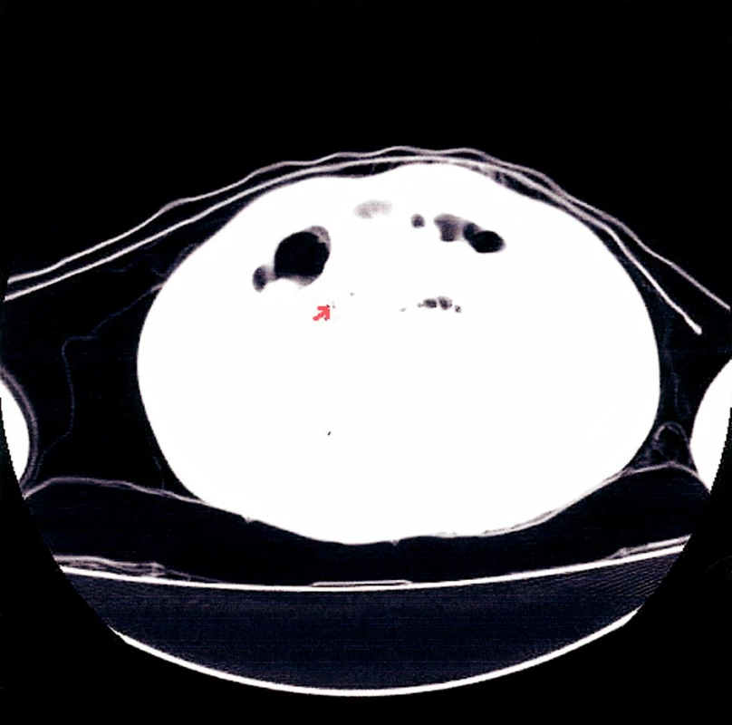 CT snímek – pneumoretroperitoneum (plicní okno)
Fig. 4. CT view – pneumoretroperitoneum (pulmonary view)