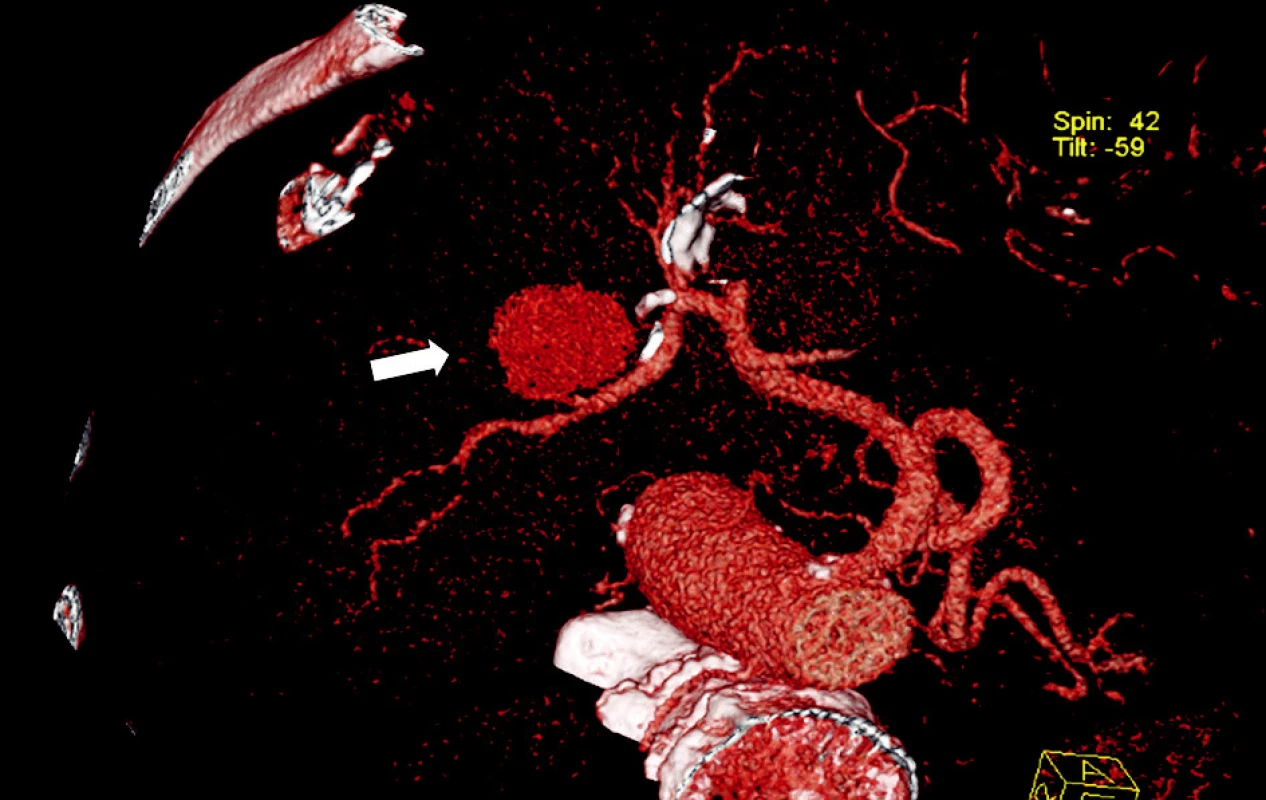 CT angiografie, 2. rekonstrukce - pseudovýduť arteria hepatica dextra (šipka)
Fig. 2. CT angiography, 2nd reconstruction – a pseudo-    aneurysm of the right hepatic artery (arrow)