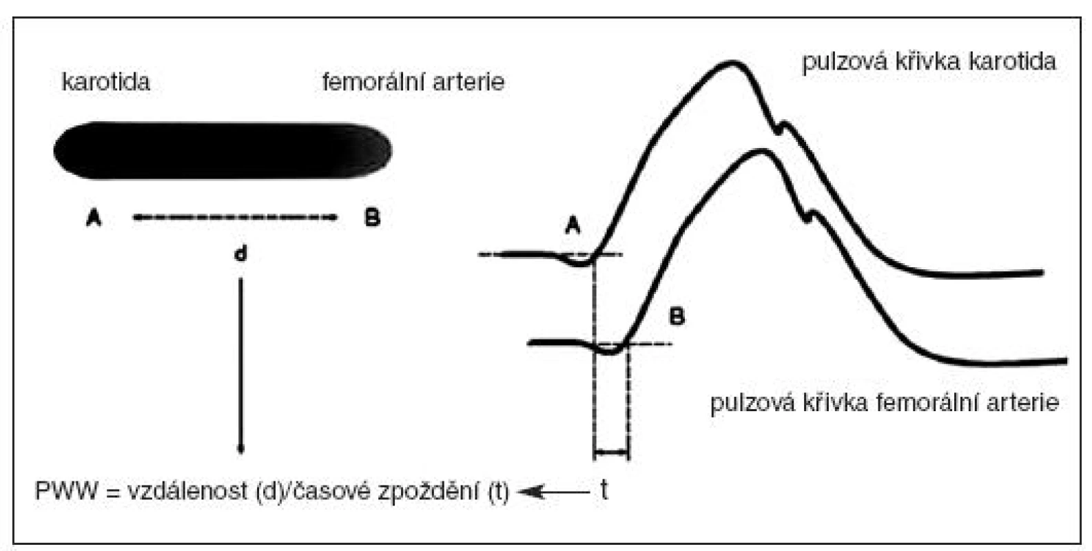 Propagácia pulznej vlny [19].