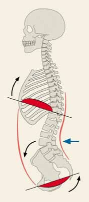 Anteverzní postavení pánve.
Fig. 4. Anteversion of the pelvis.