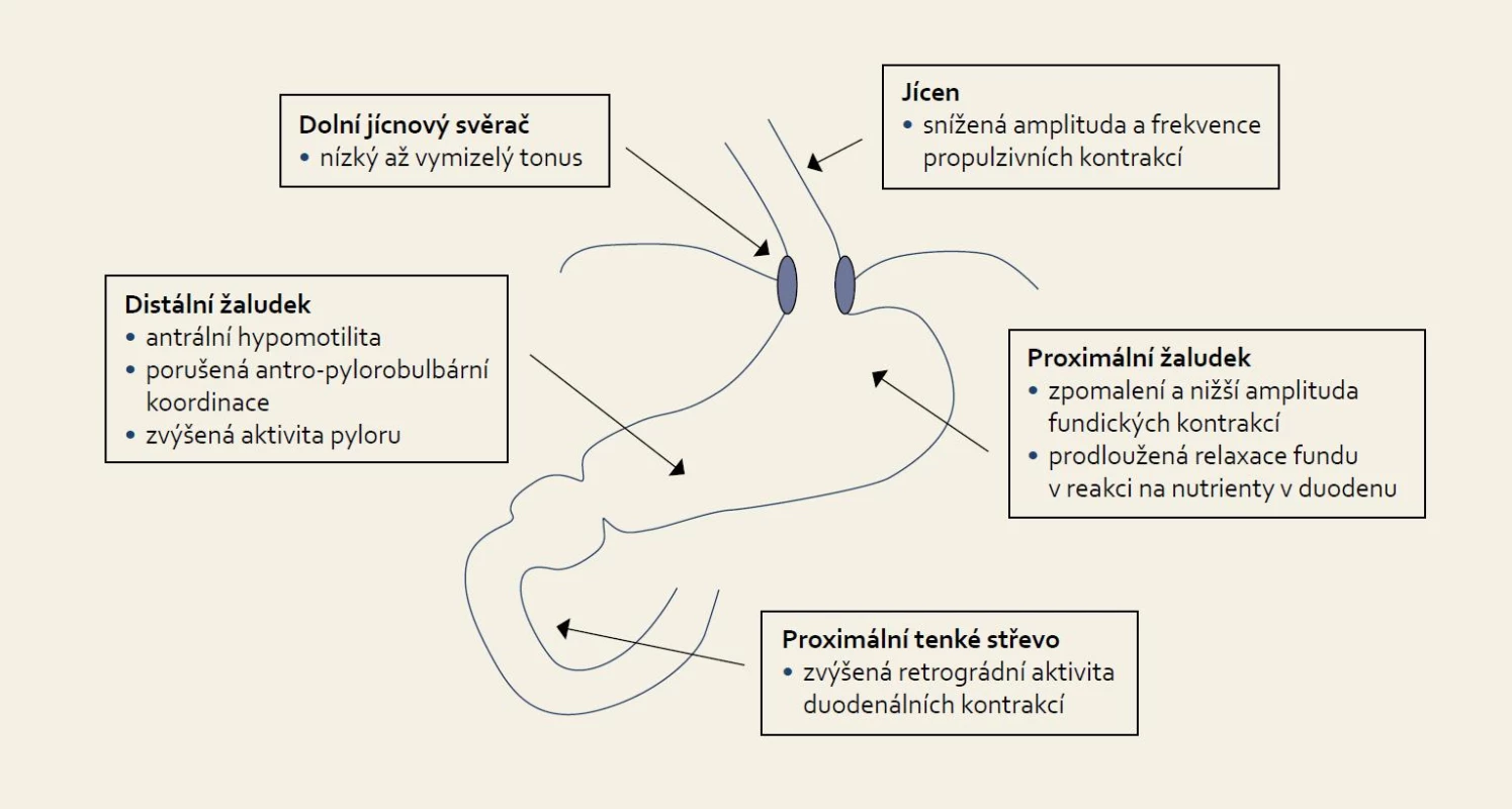 Patofyziologie dysfunkce horní části trávicího traktu u kriticky nemocných.
Fig. 1. Pathophysiology of upper gastrointestinal tract dysfunction in critically ill patients.