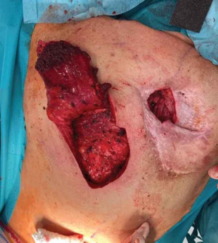Flap elevation and pedicle dissection with the defect on the right.