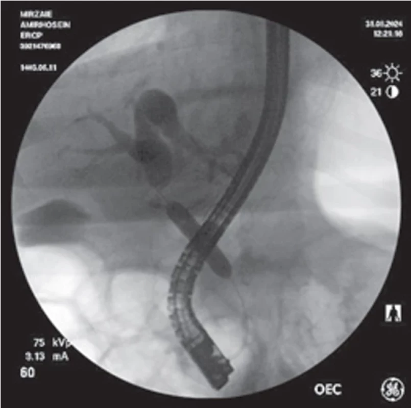 Multiple biliary strictures (hilar and CBD) in a 10-year-old male patient (patient 5). Coronary balloon (4 mm) dilation was used to manage three separate strictures, followed by the place ment of a straight plastic stent (10 Fr, 10 cm).  Obr. 5. Mnohočetné biliární striktury (hilové a CBD) u 10letého pacienta (pacient 5). Pomocí koronárního balónku (4 mm) byly rozdilatovány tři samostatné striktury a následně byl zaveden přímý plastový stent (10 Fr,10 cm).