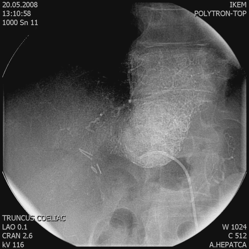 Po embolizaci je tumor vyplněn Lipiodolem
Fig. 2. Following its embolization, the tumor is filled with Lipiodol
