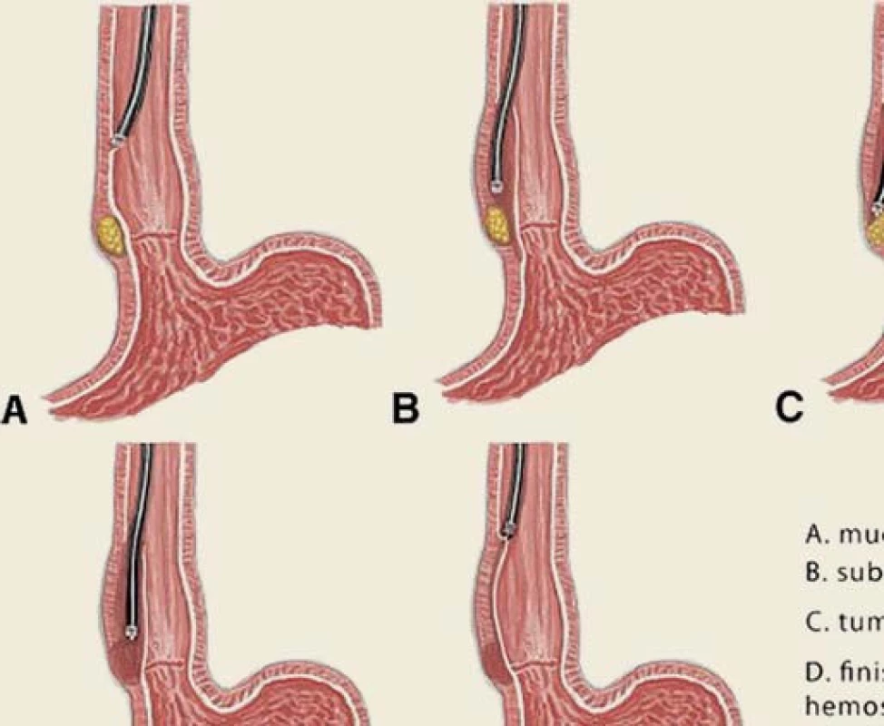 Princip STER (podrobnosti v textu) – technika umožňující resekci submukózních lézí.
Fig. 9. The STER principle (details below) – a technique allowing resection of submucosal lesions.