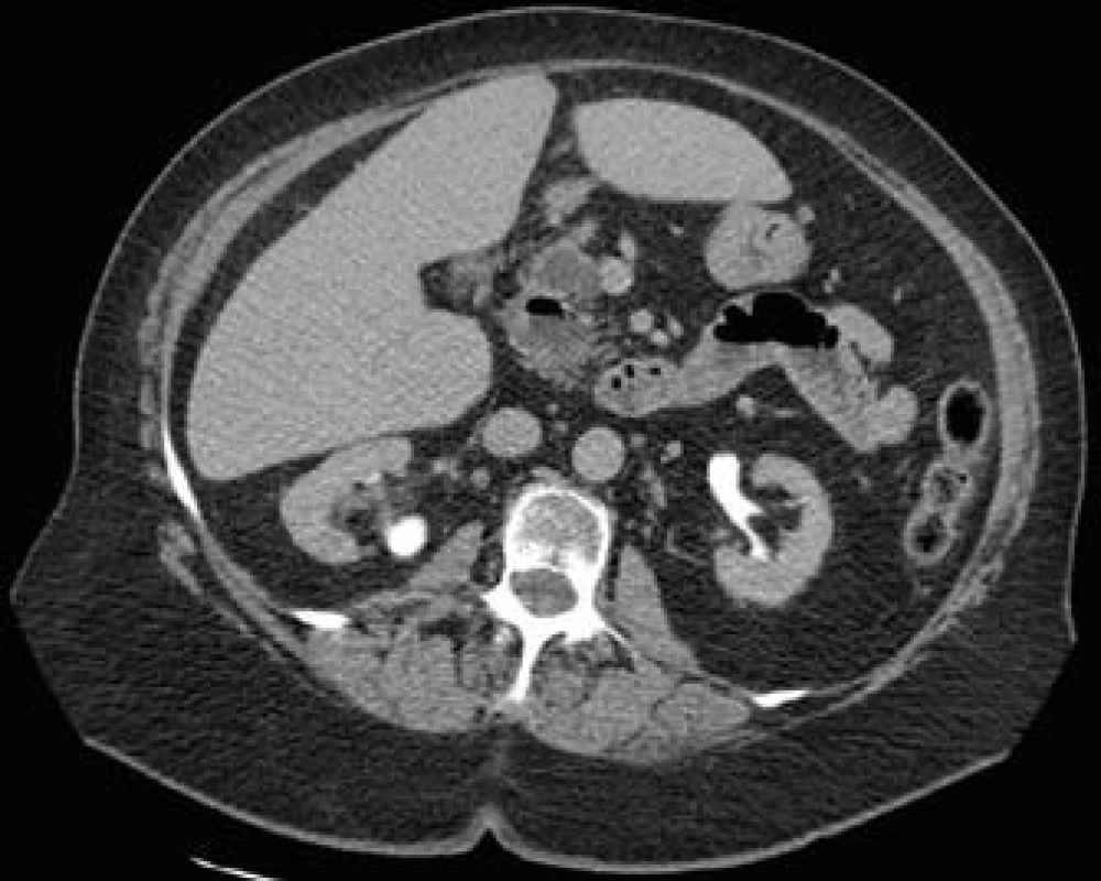 CT snímok brucha: nádor v hlave pankreasu s priemerom 23 mm.
Fig. 1. Abdominal CT scan: pancreatic head tumor with a diameter of 23 mm.