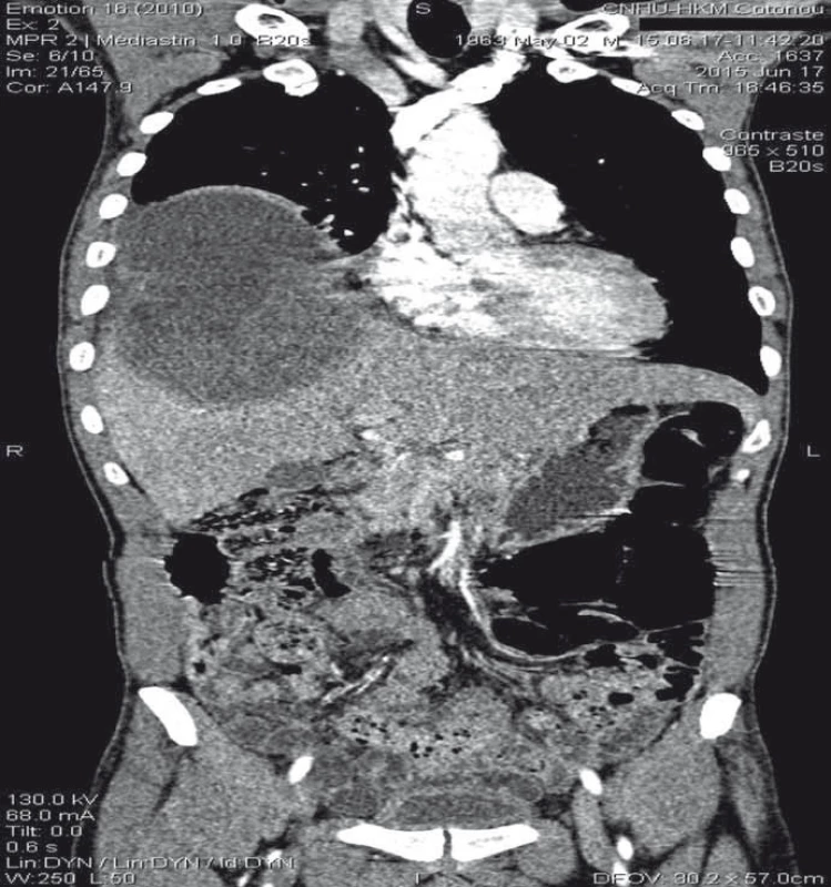 Thoracoabdominal scan (frontal cut) showing the fi stula through the diaphragm connecting a large hepatic dome abscess and right basal pulmonary abscess.<br>
Obr. 2. Snímek hrudníku a břicha (frontální řez) s nálezem fistuly vedoucí přes bránici
a spojující absces ve velkém jaterním laloku a výchozí pravostranný plicní
absces.