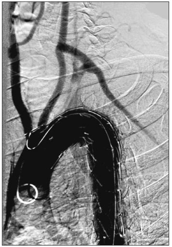 54-ročný muž s aneuryzmatickou dilatáciou anomálne odstupujúcej arteria subelavia dextra (arteria lusoria). Stav po implantácii hrudného stentgraftu do oblasti aortálneho oblúka a dodilatovaní stentgraftu. Digitálna subtrakčná angiografia aortálneho oblúka a supraaortových vetiev.
Fig. 5. A54-year old male with aneurysmal dilatation of an abnormal arteria subclavia dextra (arteria lusoria). Following thoracic stentgraft implantation into the aortic arch region and completion of the stentgraft dilation. Digital subtraction angiography of the aortic arch and supraaortic branches.