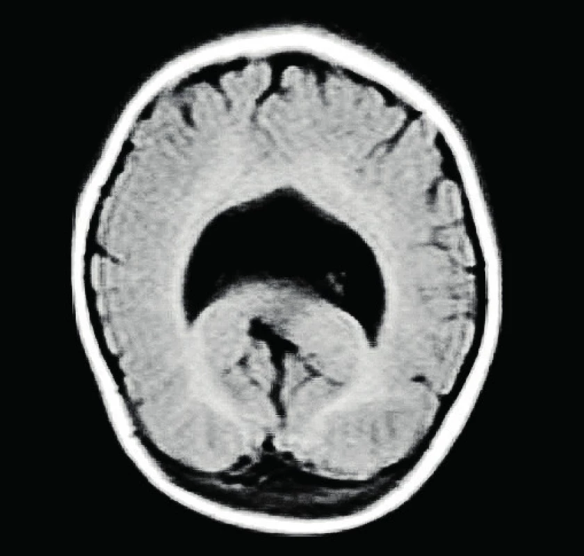 MRI mozku naší pacientky – monoventrikl naznačeně podkovovitého tvaru, s oddělenými okcipitálními rohy, hemisféry mají silnější plášť. Archiv autora.
Fig. 1. Magnetic resonance imaging of the brain of our patient – monoventricle of horseshoe shape, with separated occipital corners, the hemispheres have thicker coat. Author’s archive