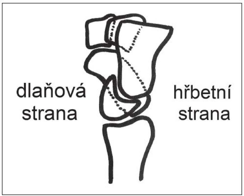 Zvětšený SL úhel (schéma boční projekce zápěstí).