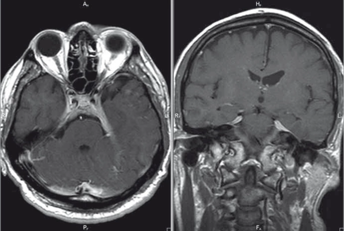 MR mozku, postkontrastní T1 vážené obrazy v axiální/koronární rovině; patologické pachymeningeální ztluštění tentoria – kazuistika 1.
Fig. 1. Brain MRI, contrast-enhanced T1-weighted images in the axial/coronal plane; pachymeningeal pathological thickening of tentoria – a case report 1.