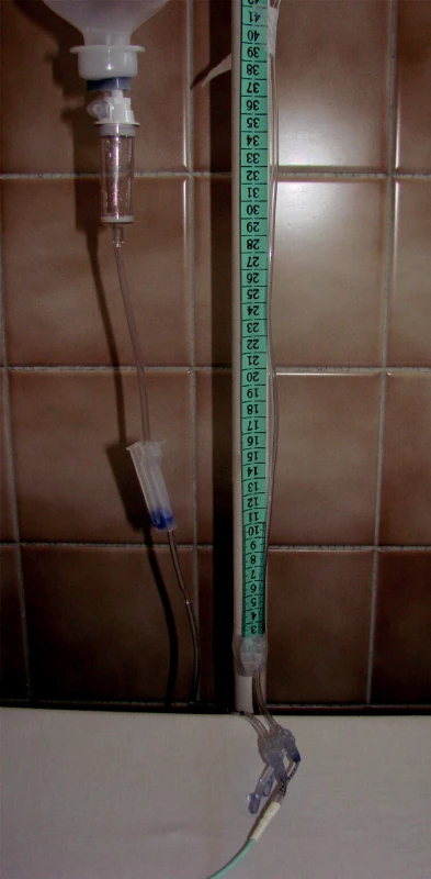 Využití dvojcestné cévky, kdy jedním kanálem je prováděno plnění močového měchýře infuzním roztokem umístěným 20 cm nad úrovní symfyzy, druhý kanál je využit k monitoraci změn tlaku během plnění prostřednicvím zkráceného infuzního setu připevněného na stojan s měřítkem.