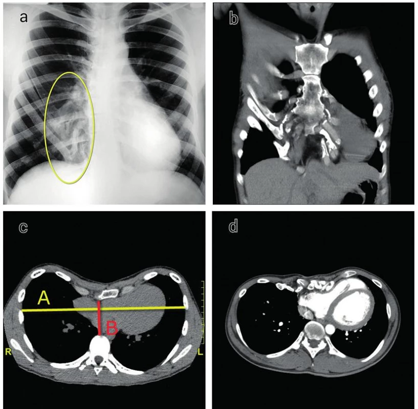Zobrazovacie vyšetrenia u pacientov s recidívou pectus excavatum
a) PA projekcia u 27 ročnej pacientky s nálezom výraznej osifikácie chrupaviek rebier
b) Koronárna rekonštrukcia u tej istej pacientky
c) Hodnotenie Hallerovho indexu (HI= A/B) u pacienta s recidívou pectus excavatum
d) Kompresia pravostranných srdcových oddielov u pacienta s recidívou pectus excavatum
Fig. 2. Radiological evaluation in patients with recurrent pectus excavatum
a) CXR in a 27-year-old female with ossification of the costal cartilages
b) Coronal reformation in the same patient
c) Haller index evaluation (HI=A/B) in a patient with recurrent pectus excavatum
d) Cardiac compression in a patient with recurrent pectus excavatum