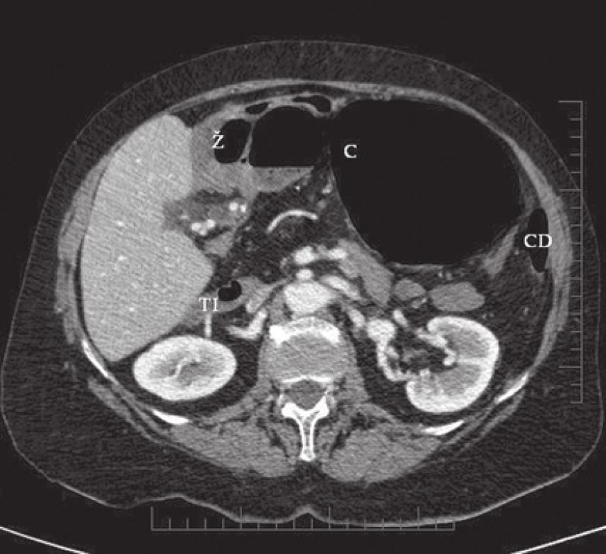 Revize CT vyšetření, kde je patrné terminální ileum vstupující do omentální burzy −transverzální řez (Ž – žaludek, C – c. caecum, CD – c. descendens, TI - terminální ileum)
Fig. 4: Revised pre-op CT scan showing terminal ileum entering the lesser sac − transverse scan (Ž – stomach, C – cecum, CD – c. descendens, TI – terminal ileum)