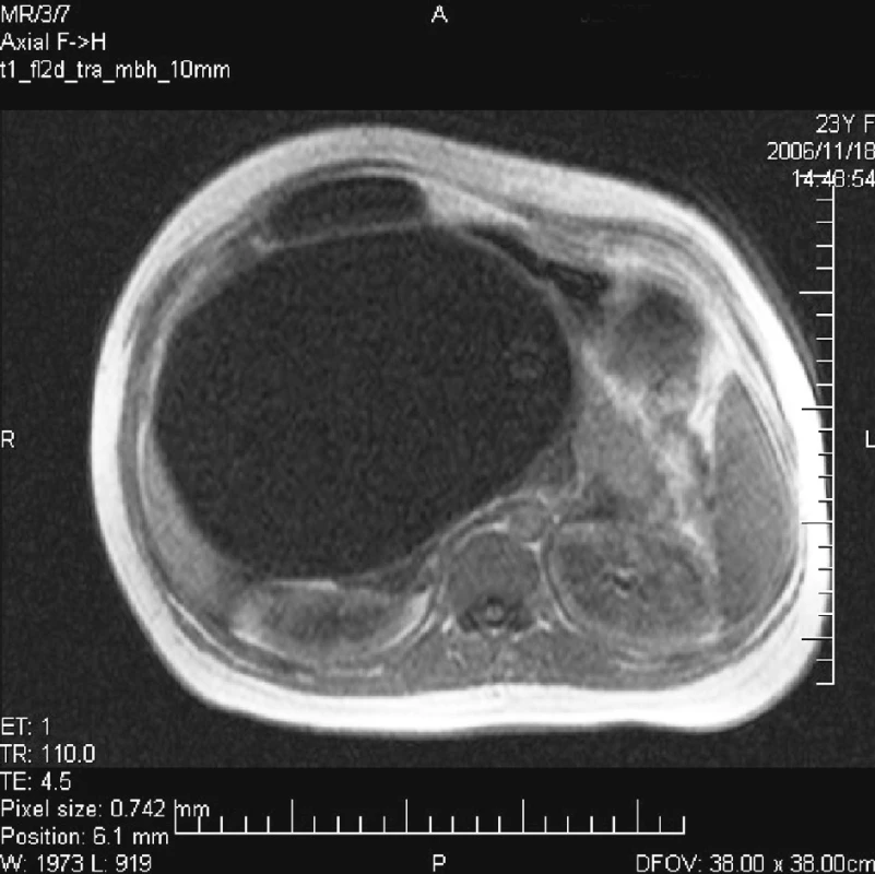 MR nález cystického útvaru dutiny brušnej
Pic. 2. MR finding of a cystic formation within the abdominal cavity