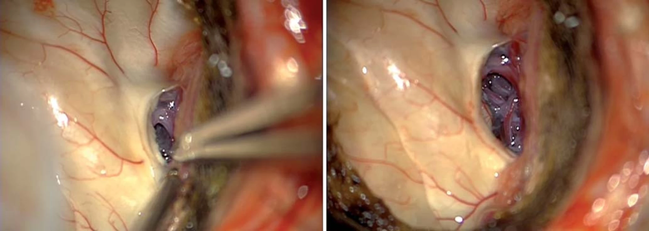 Transchoroidální preparace hippokampu.
Fig. 7. Transchoroidal preparation of the hippocampus.