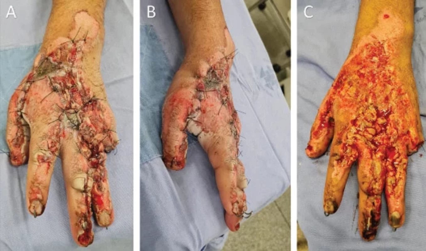 A) Initial appearance of the hand 7 days after the patient's admission, treated with daily dressings of rayon gauze and sunfl ower oil, superior view; B) lateral view; C) fi nal appearance after the fi rst debridement by the plastic surgery team before performing the fat graft and vacuum dressing.