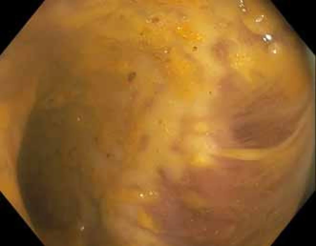 Toxické megakolon při klostridiové enterokolitidě.
Fig. 6. Pseudomembranous colitis with toxic megacolon.